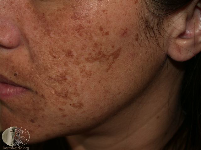 melasma dermatologist Waynesboro va