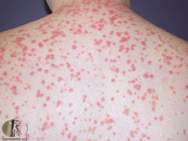 triggers for psoriasis