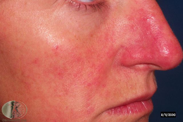 Rosacea Dermatologist Dr. Keith A. Knoell