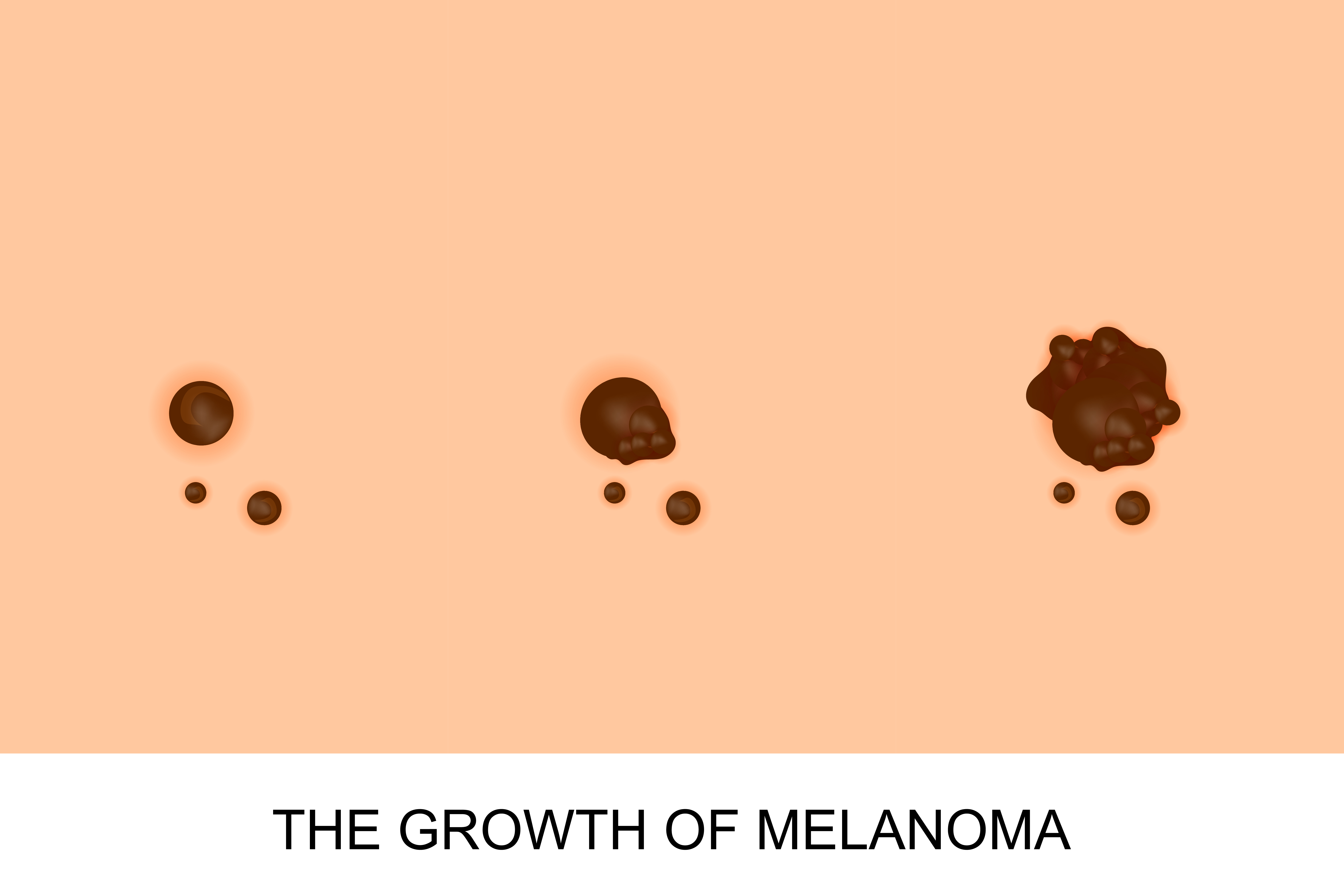 Melanoma Growth