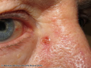 Basal cell carcinoma skin specialist