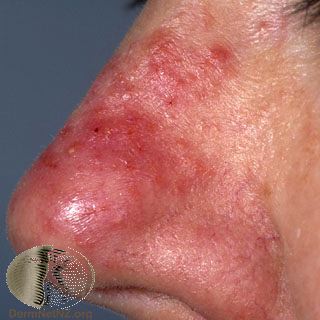 rosacea dermatologist, waynesboro va