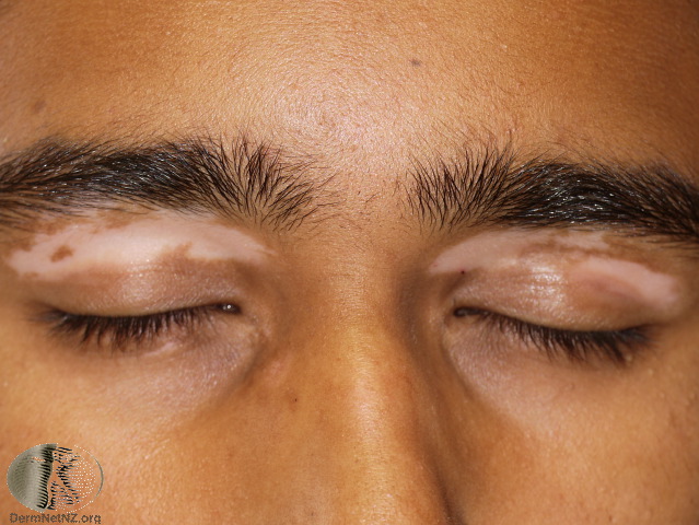 Vitiligo affects the eye area