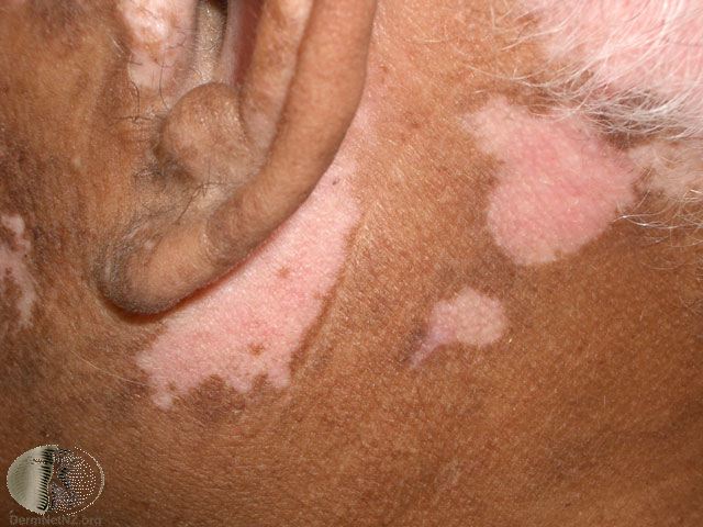 vitiligo dermatologist Dr. Keith Knoell